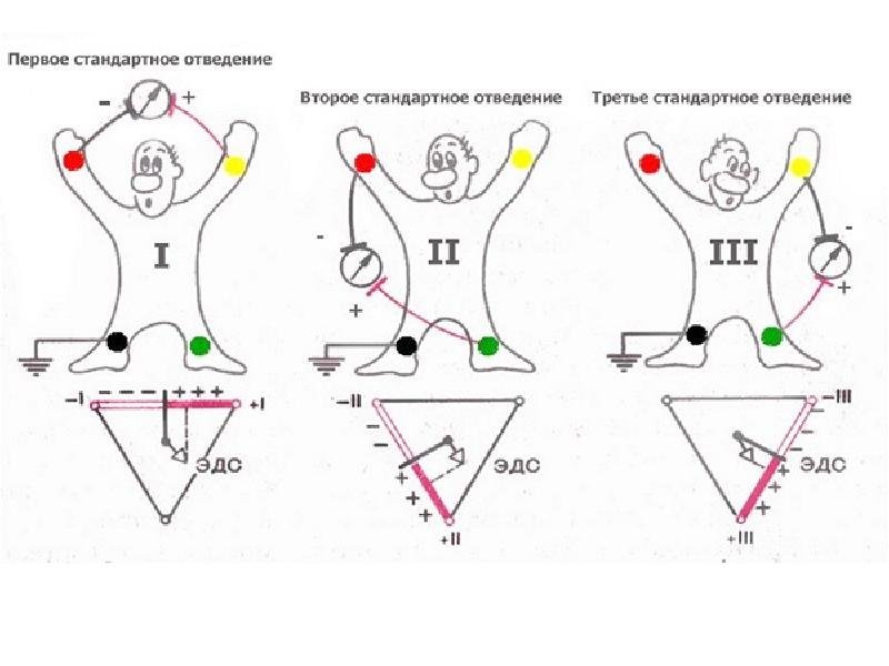 Экг точки наложения электродов рисунок просто фото