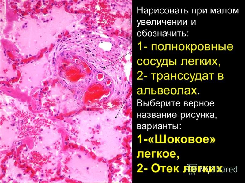 Геморрагический инфаркт легкого микропрепарат рисунки фото