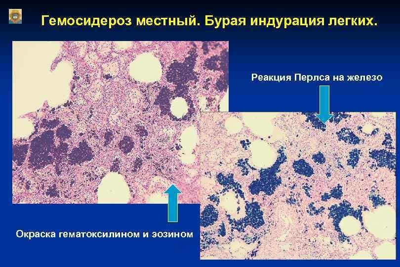 Микропрепарат бурая индурация легких рисунки фото