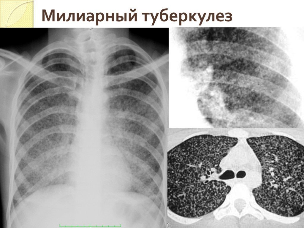 Милиарный туберкулез легких рисунки фото