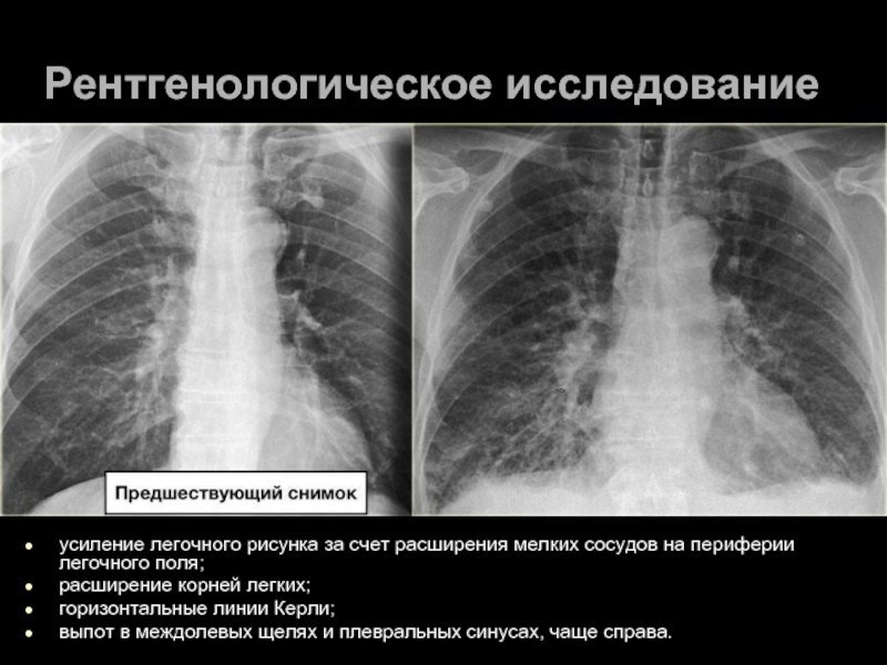 Острая деформация сосудистого рисунка легких у ребенка фото