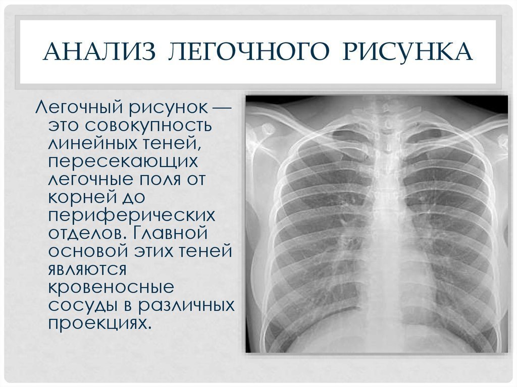 Сосудистый рисунки легких усилен фото