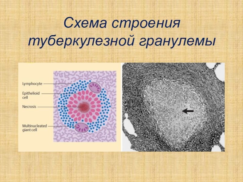 Туберкулезные бугорки в легком рисунки фото