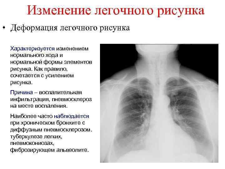 Усиление сосудистого рисунка легких фото