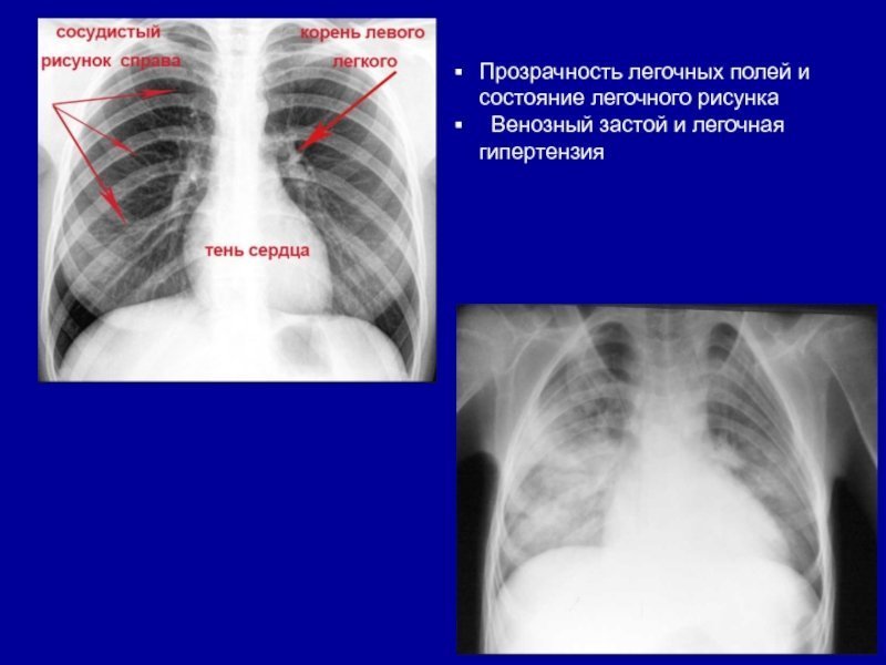 Усиление сосудистого рисунка легких у ребенка фото