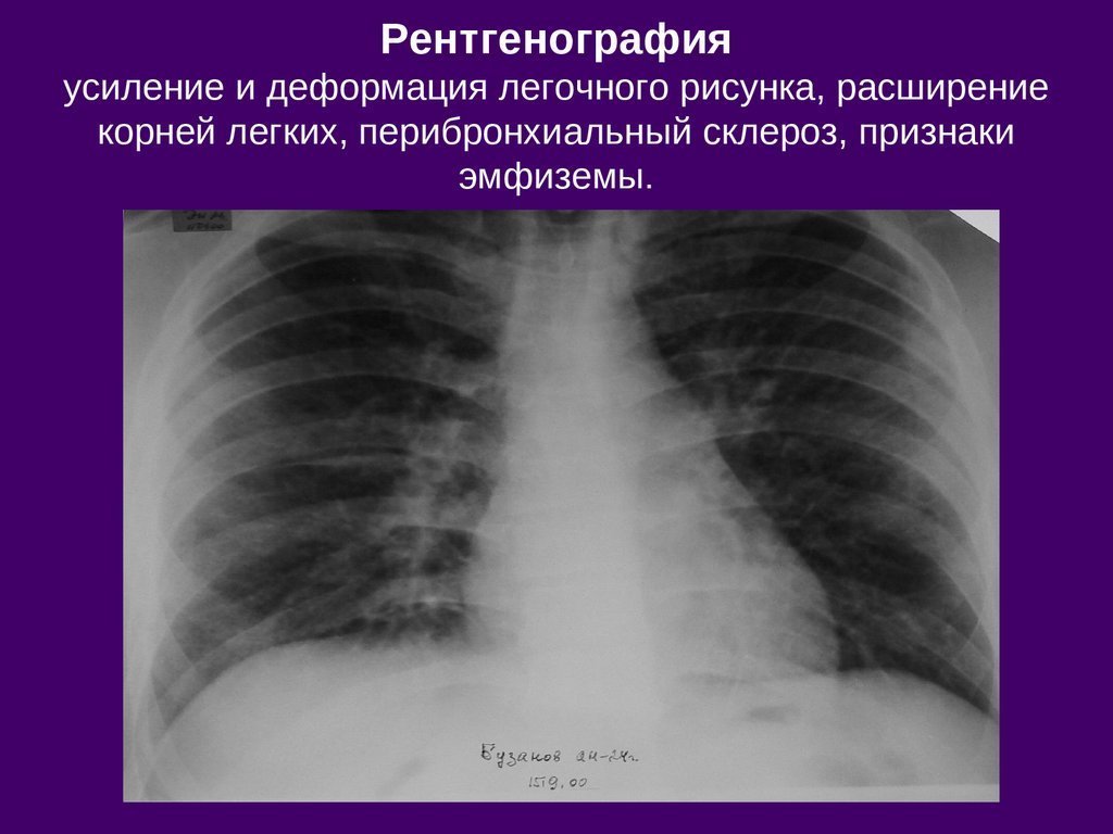 Усиленный рисунки легких фото